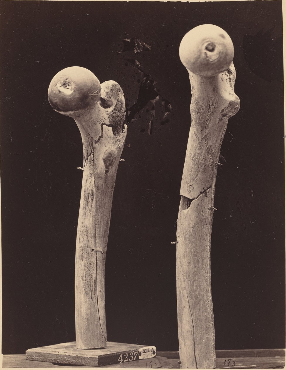 Specimens of Gunshot Fractures of the Femur by American 19th Century