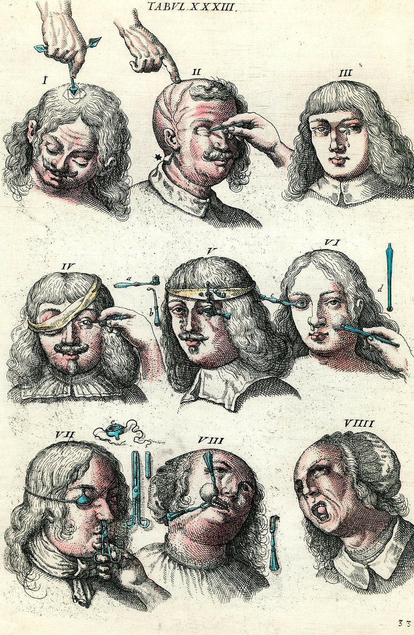 Surgery in the 18th century: Trepanation and operation of the eye and face. Engraving in 