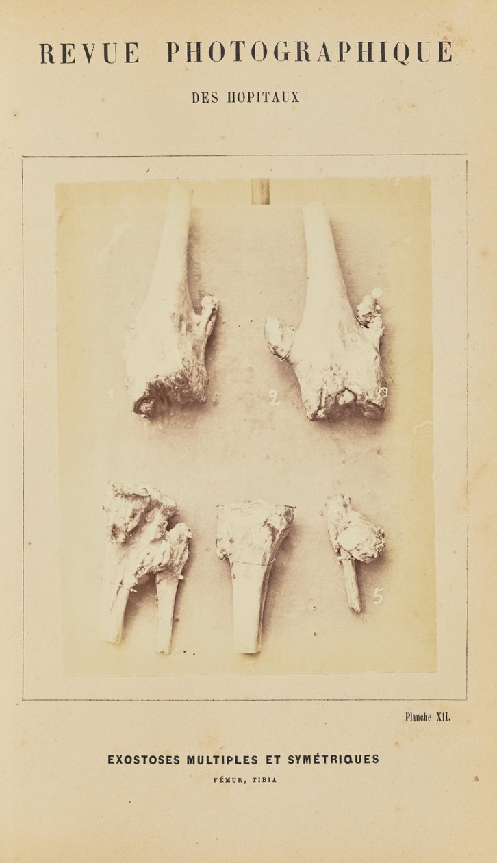 Multiple and Symmetrical Exostoses, Femur, Tibia by Arthur de Montmeja