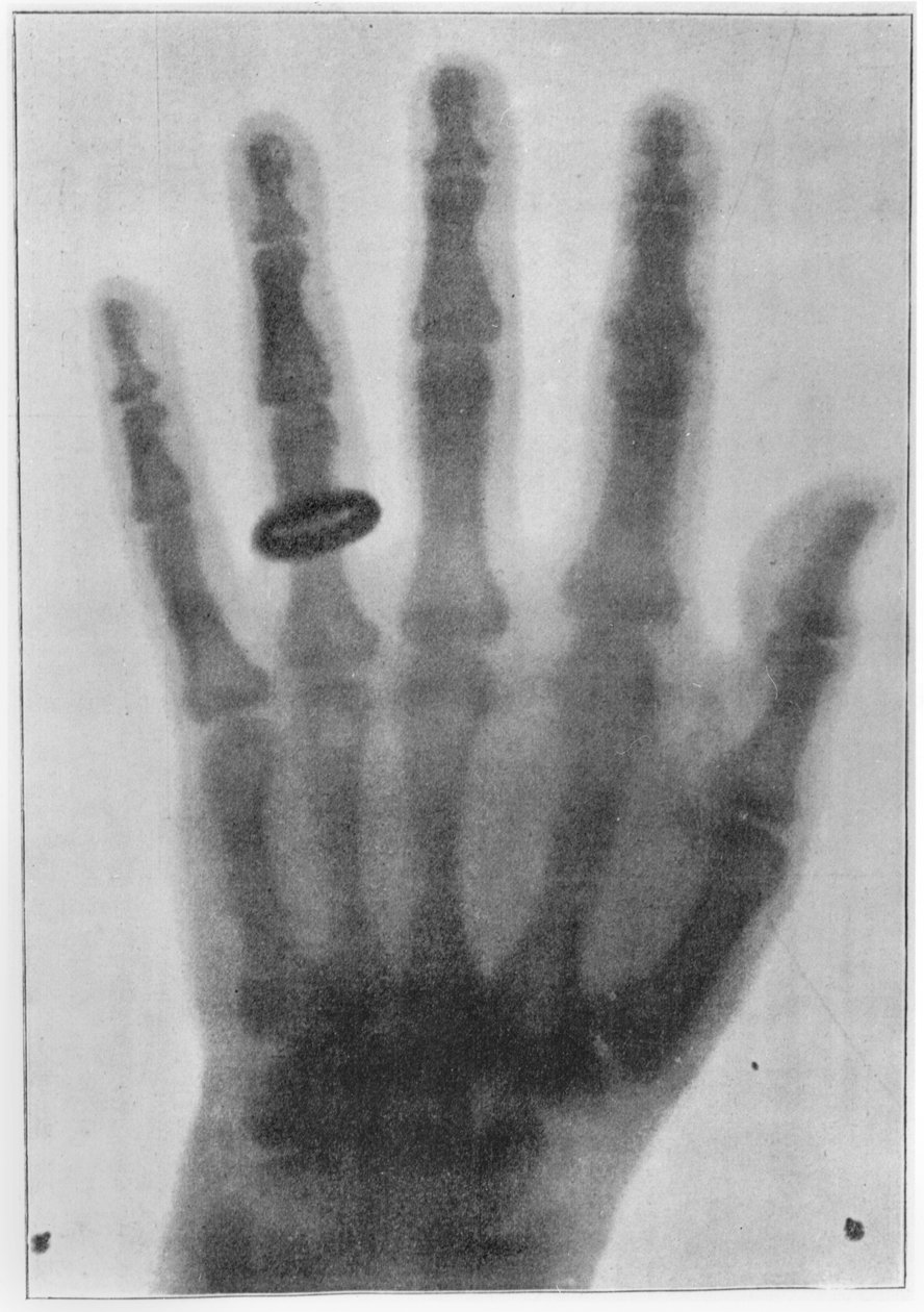 X-ray of the Left Hand of Anna Bertha Ludwig, Röntgen
