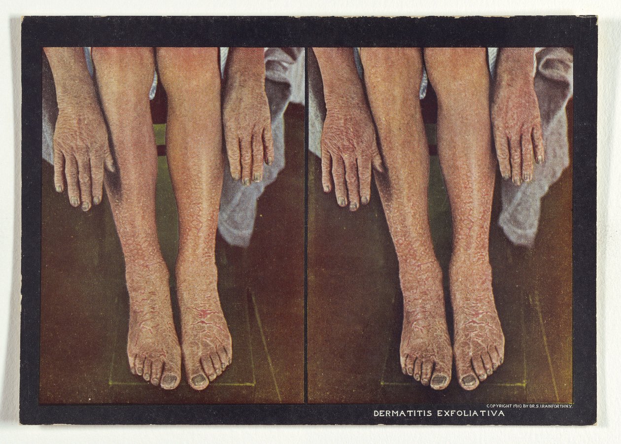 Exfoliative Dermatitis by Dr. Selden I. Rainforth