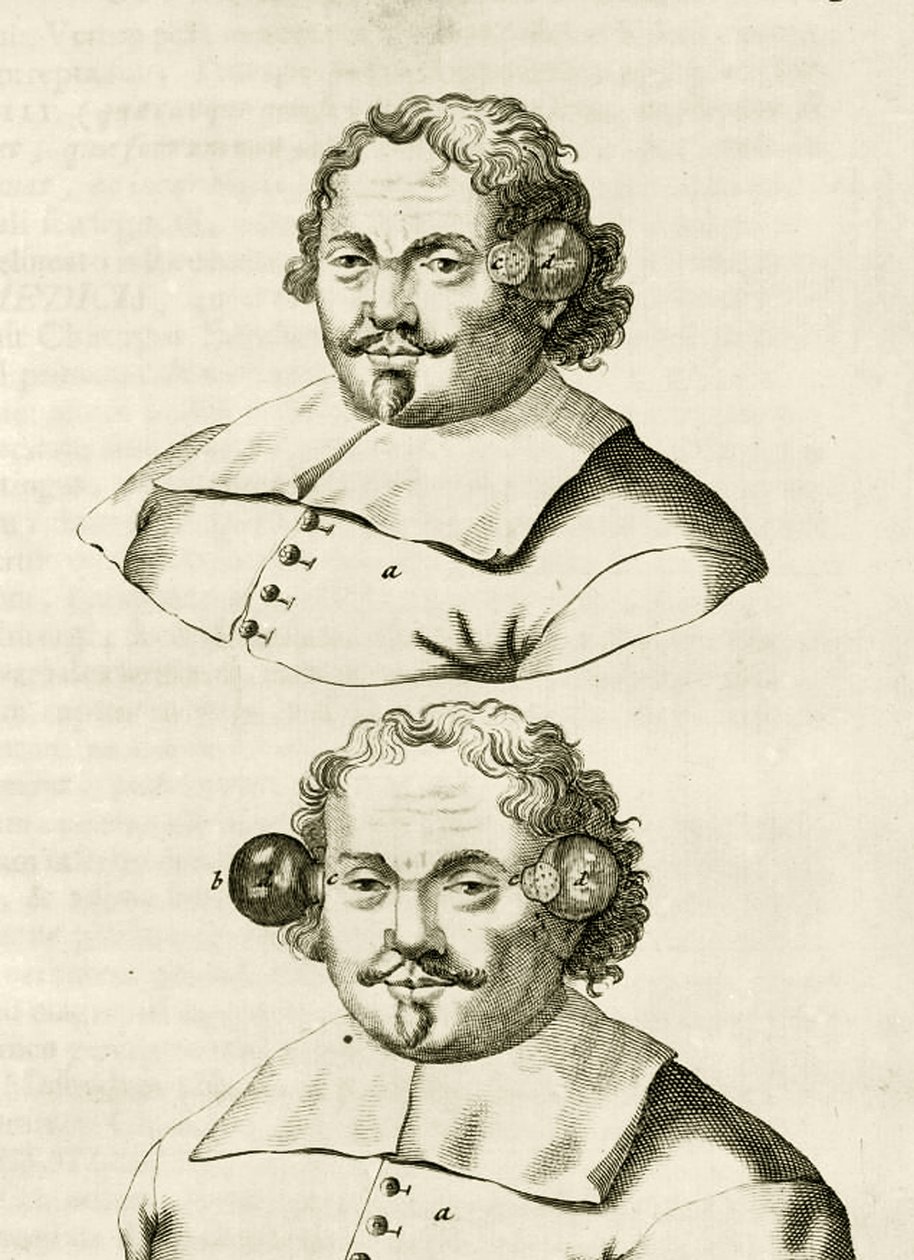 An example of cupping, from Exercitationes Practicae circa Medendi Methodum by Frederik Dekkers, 1694 by Dutch School