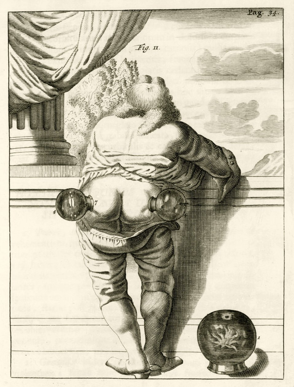 An example of cupping, from Exercitationes Practicae circa Medendi Methodum by Frederik Dekkers, 1694 by Dutch School