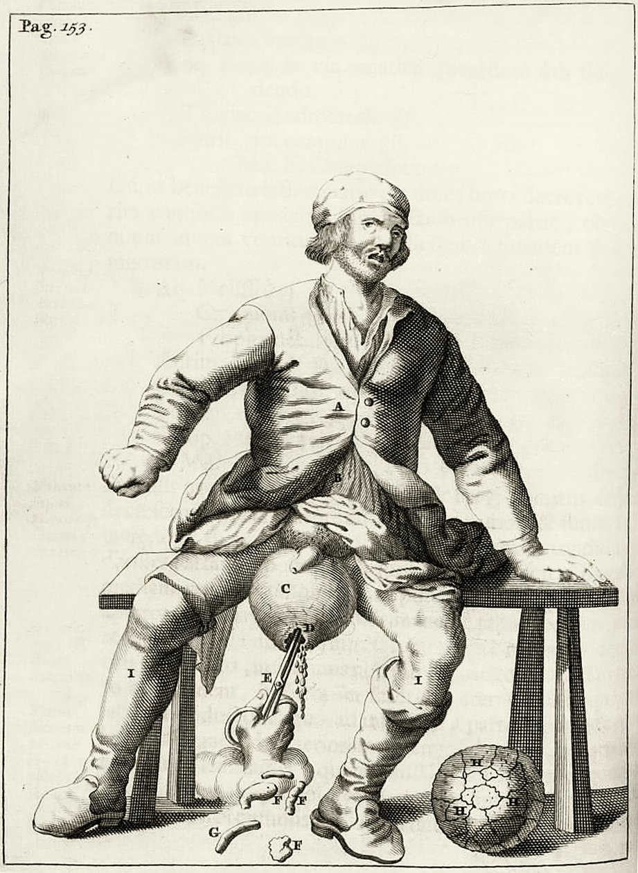 Draining fluid from a Hydrocele of the Scrotum, from Exercitationes Practicae circa Medendi Methodum by Frederik Dekkers, 1694 by Dutch School