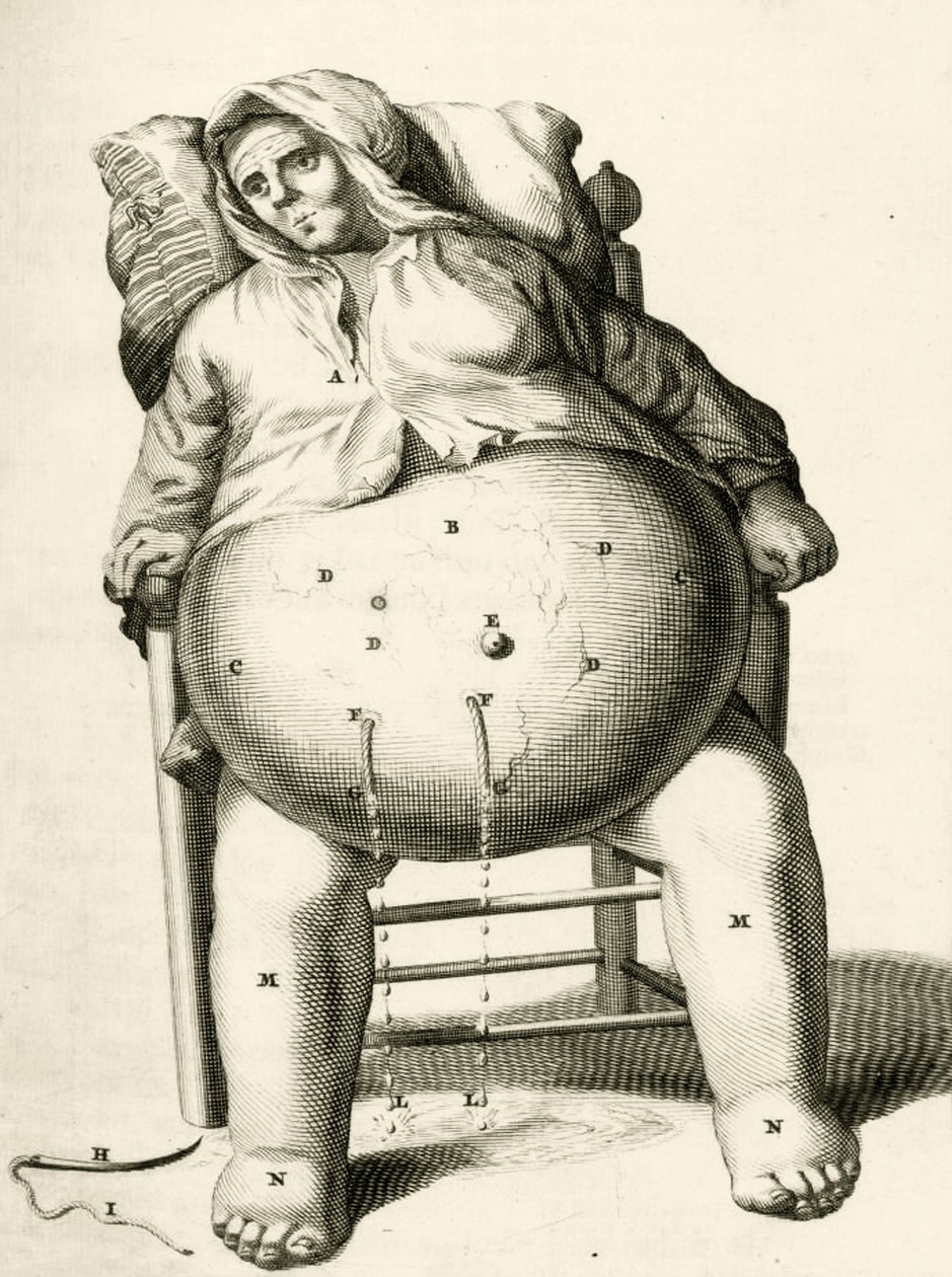 Draining fluids from an abscess, from Exercitationes Practicae circa Medendi Methodum by Frederik Dekkers, 1694 by Dutch School