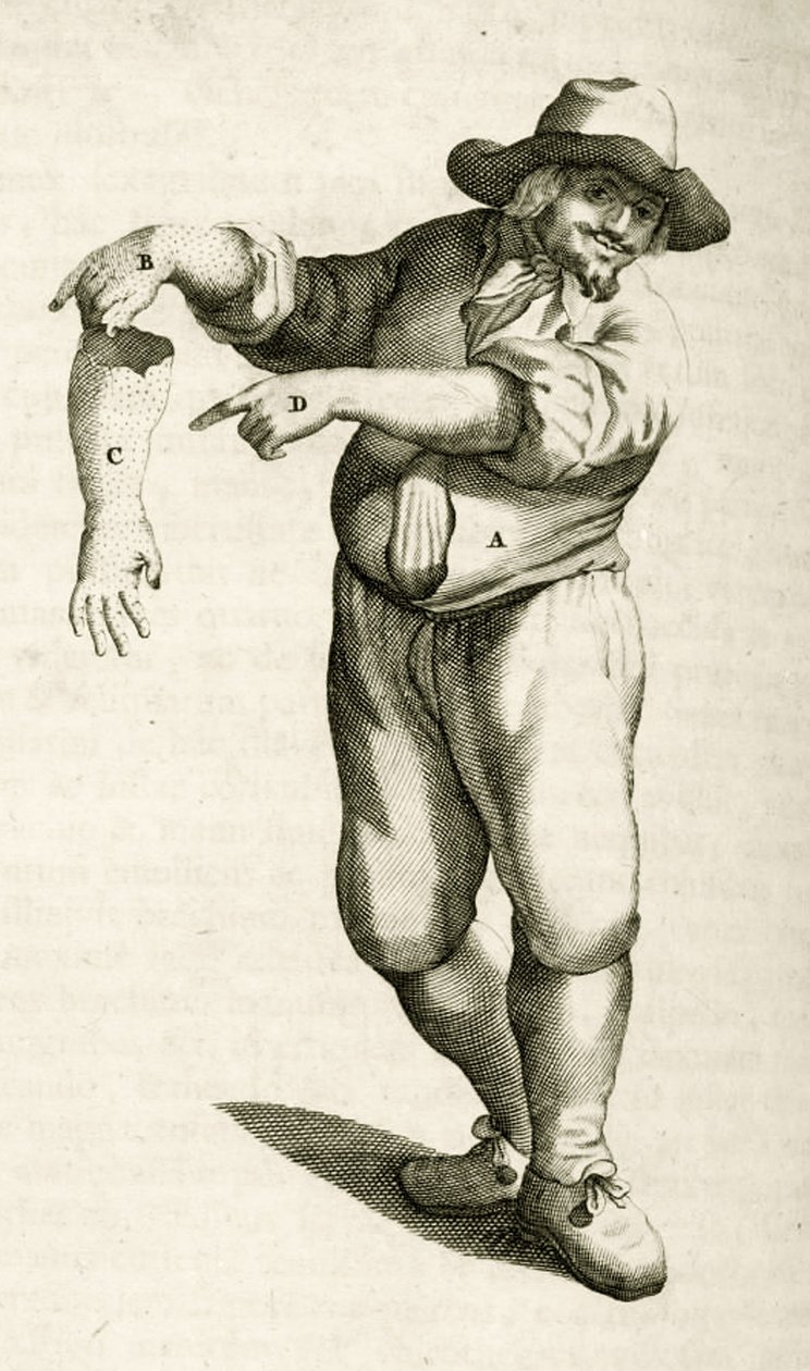 Removing dead skin with pustules, from Exercitationes Practicae circa Medendi Methodum by Frederik Dekkers, 1694 by Dutch School