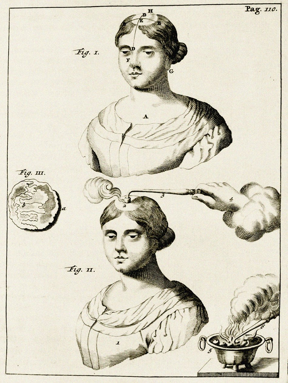 Treating a sufferer of Epilepsy, from Exercitationes Practicae circa Medendi Methodum by Frederik Dekkers, 1694 by Dutch School