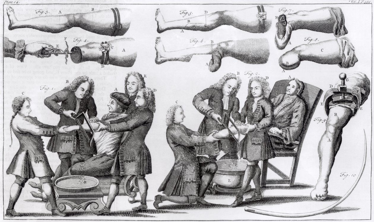 Surgical Operations on Limbs by English School
