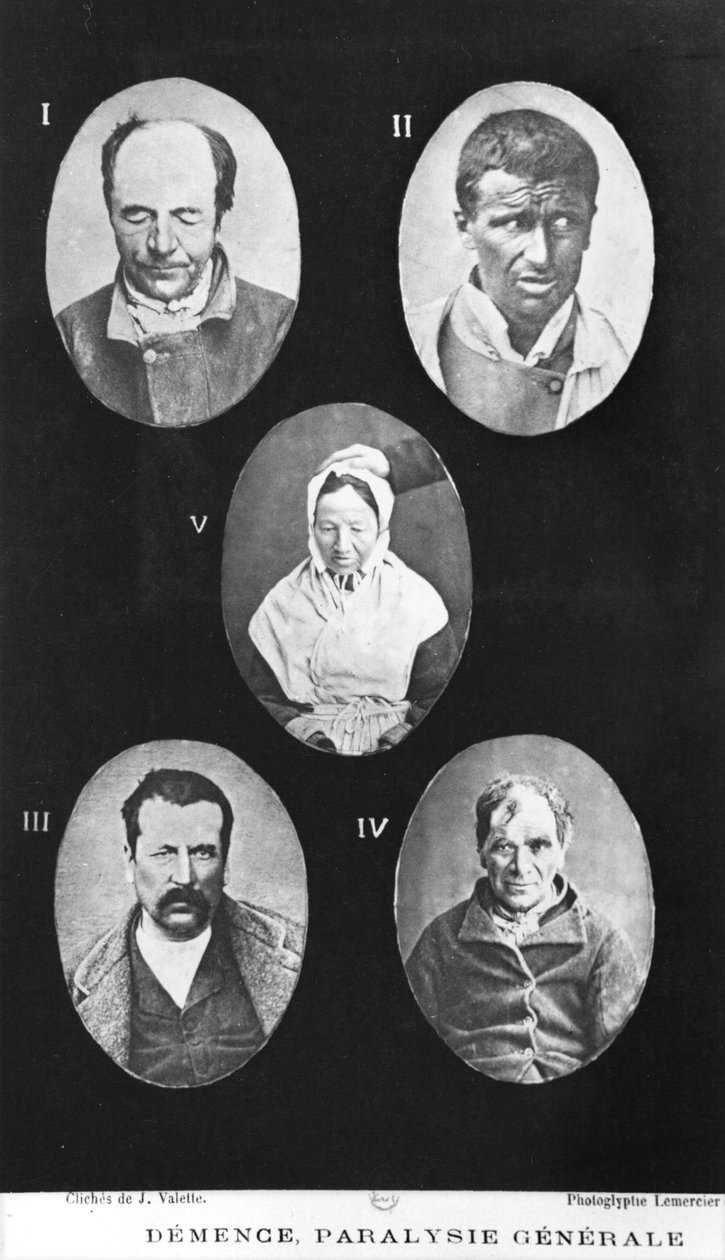 Dementia, General Paralysis, Illustration from Nouveau Traite Elementaire et Pratique des Maladies Mentales by Henri Dagonet by French Photographer