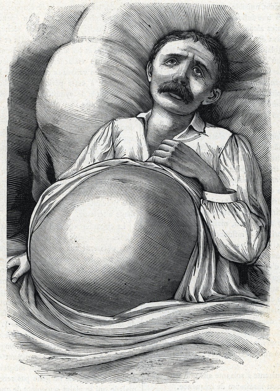 Patient with advanced liver cirrhosis (engraving) 1888 by French School