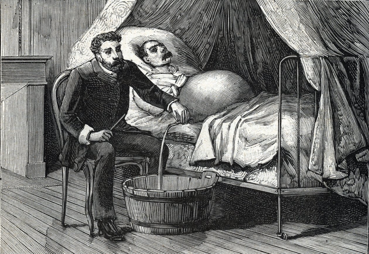 Patient with advanced liver cirrhosis, doctor performing a puncture (engraving, 1888) by French School