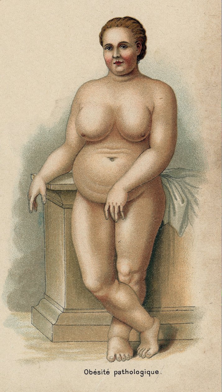 Portrait of a Woman with Pathological Obesity by French School