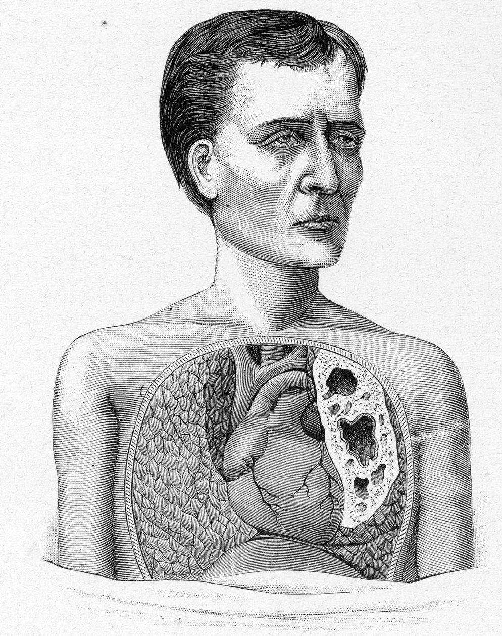 Representation of a person with caves, complication of tuberculosis by French School