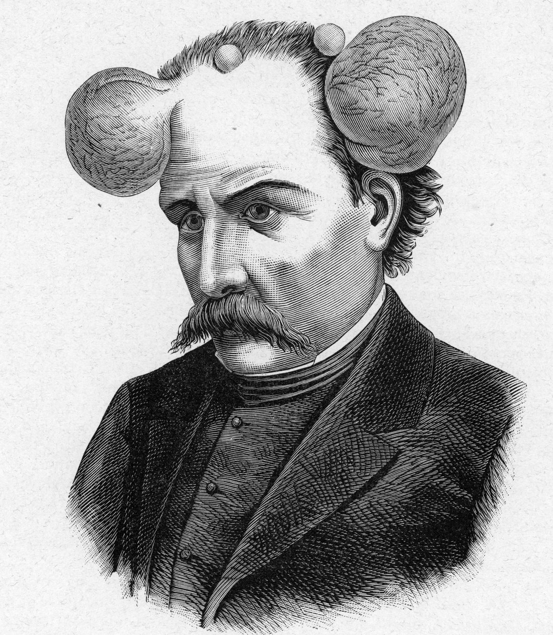 Representation of a person with magnifying glass, scalp cysts by French School