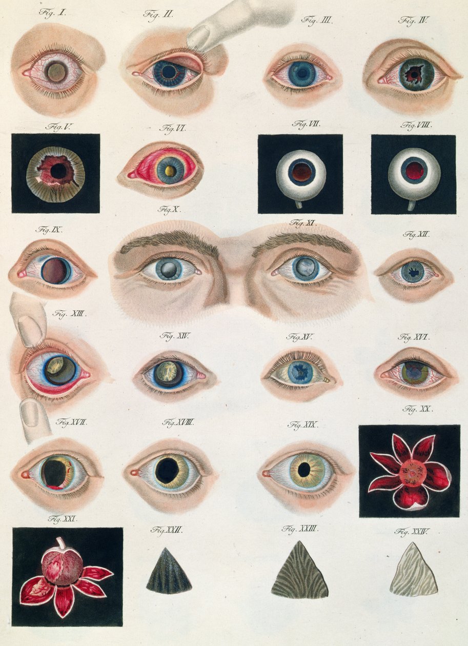 Description of congenital eye anomalies, from Klinische Darstellungen der Krankheiten und Blidungsfehler des Menschlichen Auges, by Friedrich August von Ammon, 1838 by German School