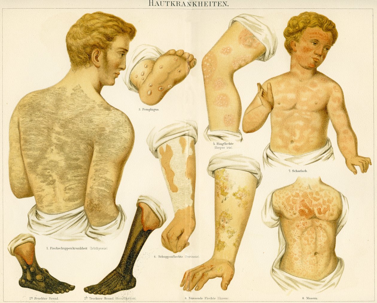 Skin Disorders, c.1890 by German School
