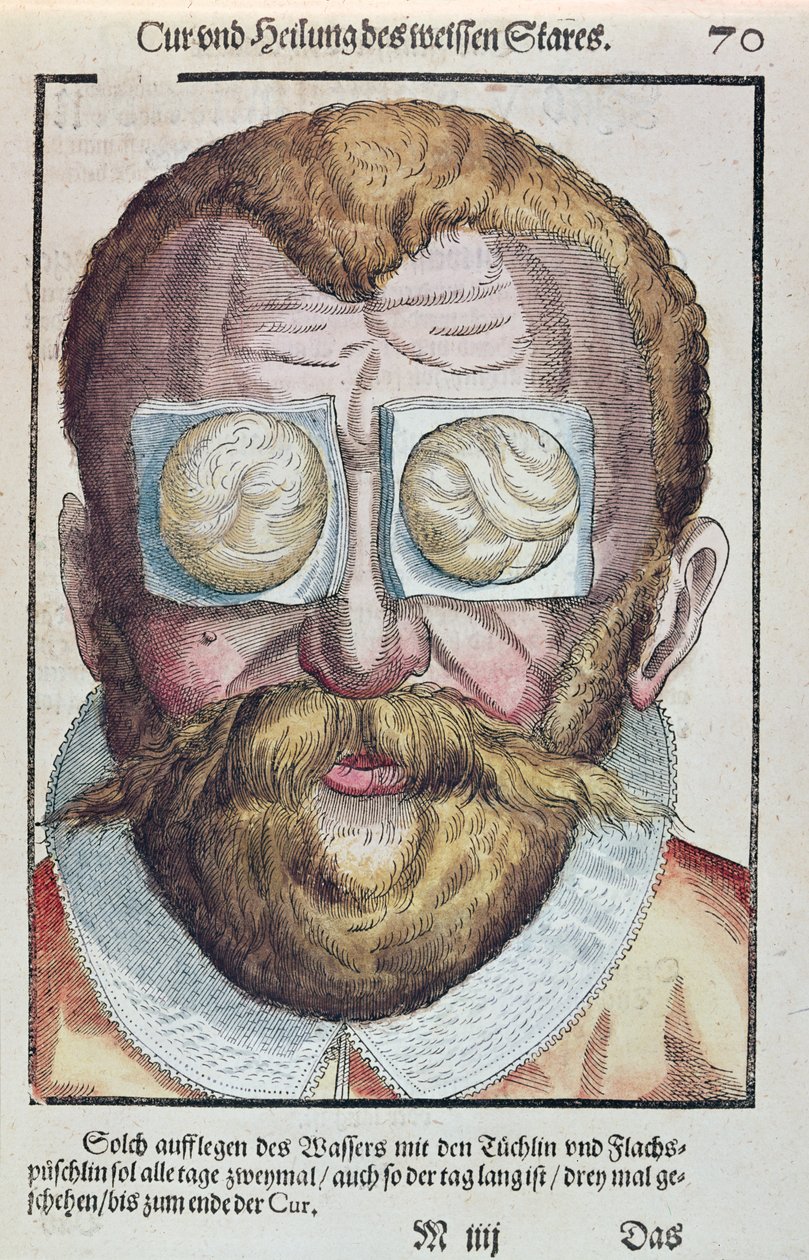 Treating an Eye Condition, from Ophthalmodouleia by Georg Bartisch, published in Dresden in 1583 by German School