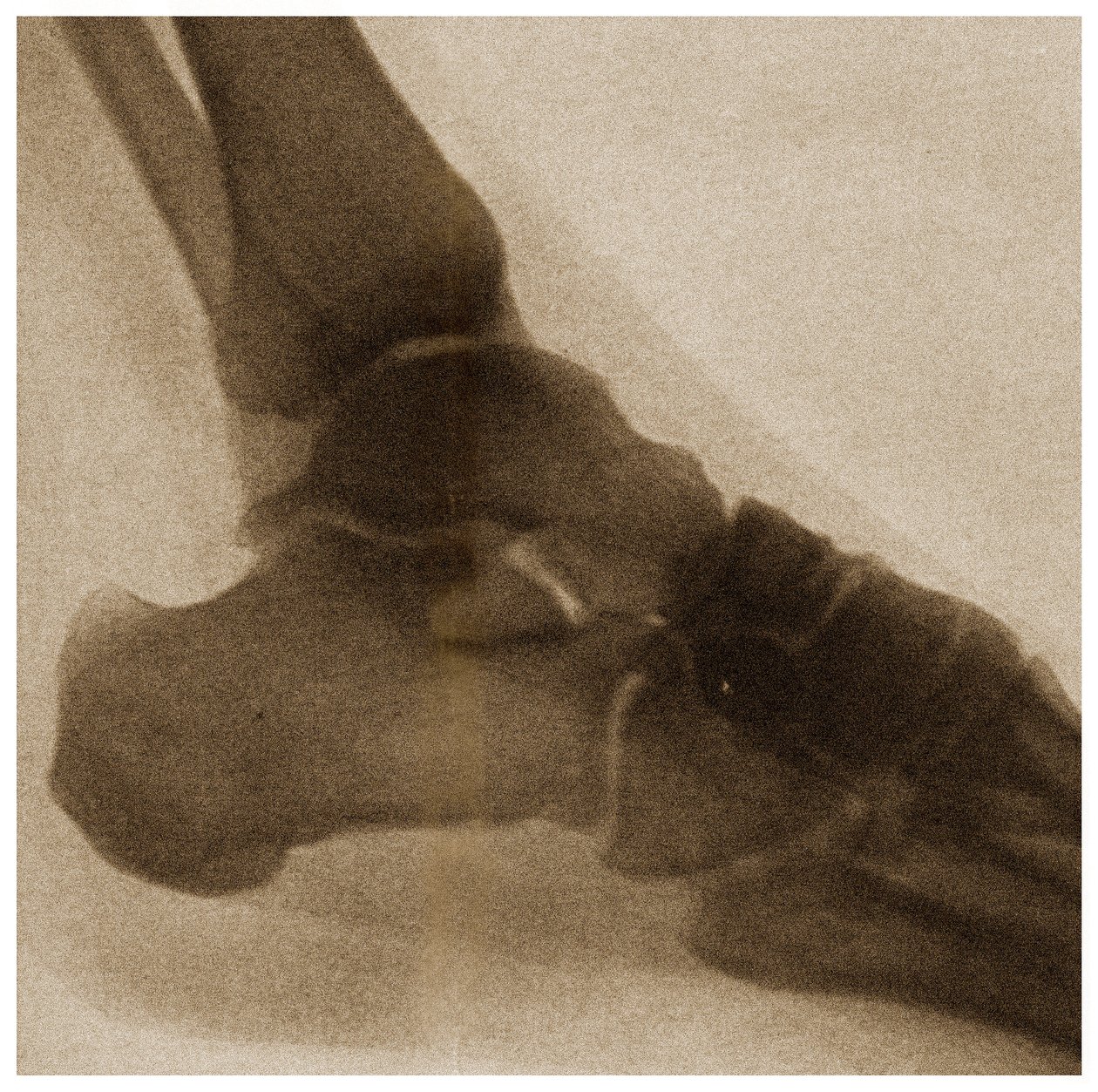 X Ray of an Ankle by German School