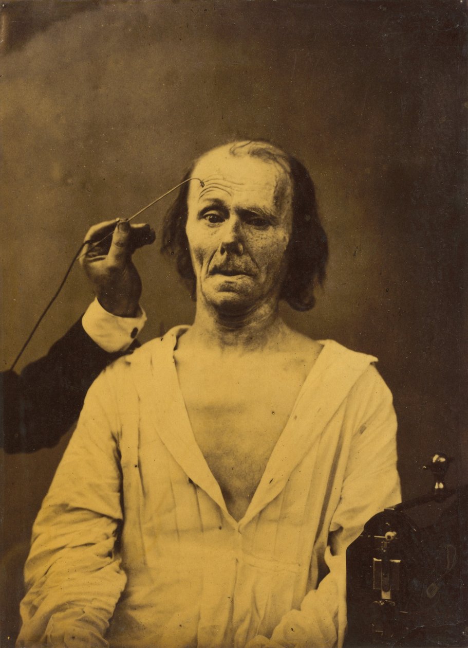 A Relaxed Face (Left); Profound Attention (Right), 1854-1856, Printed 1862 by Guillaume Benjamin Armand Duchenne de Boulogne