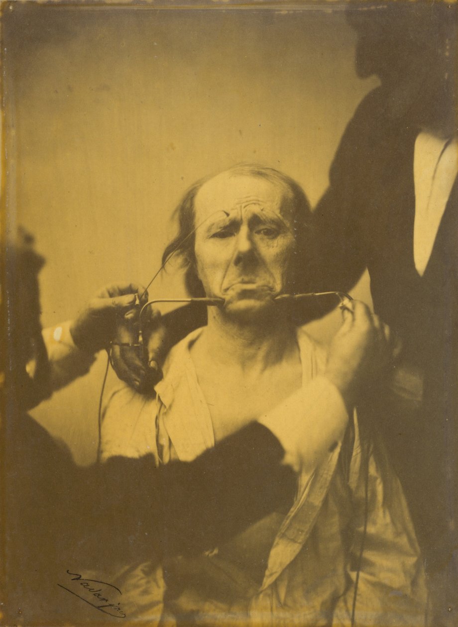 Pain and Despair, 1854-1856, Printed 1862 by Guillaume Benjamin Armand Duchenne de Boulogne
