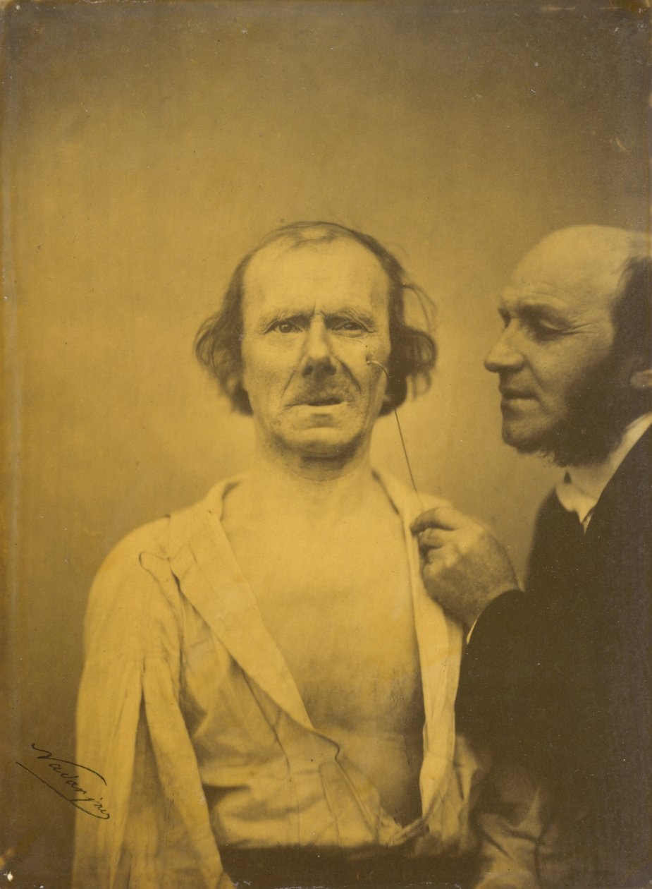 Weeping, tears of pity (left); Relaxed face (right) by Guillaume-Benjamin-Armand Duchenne de Boulogne