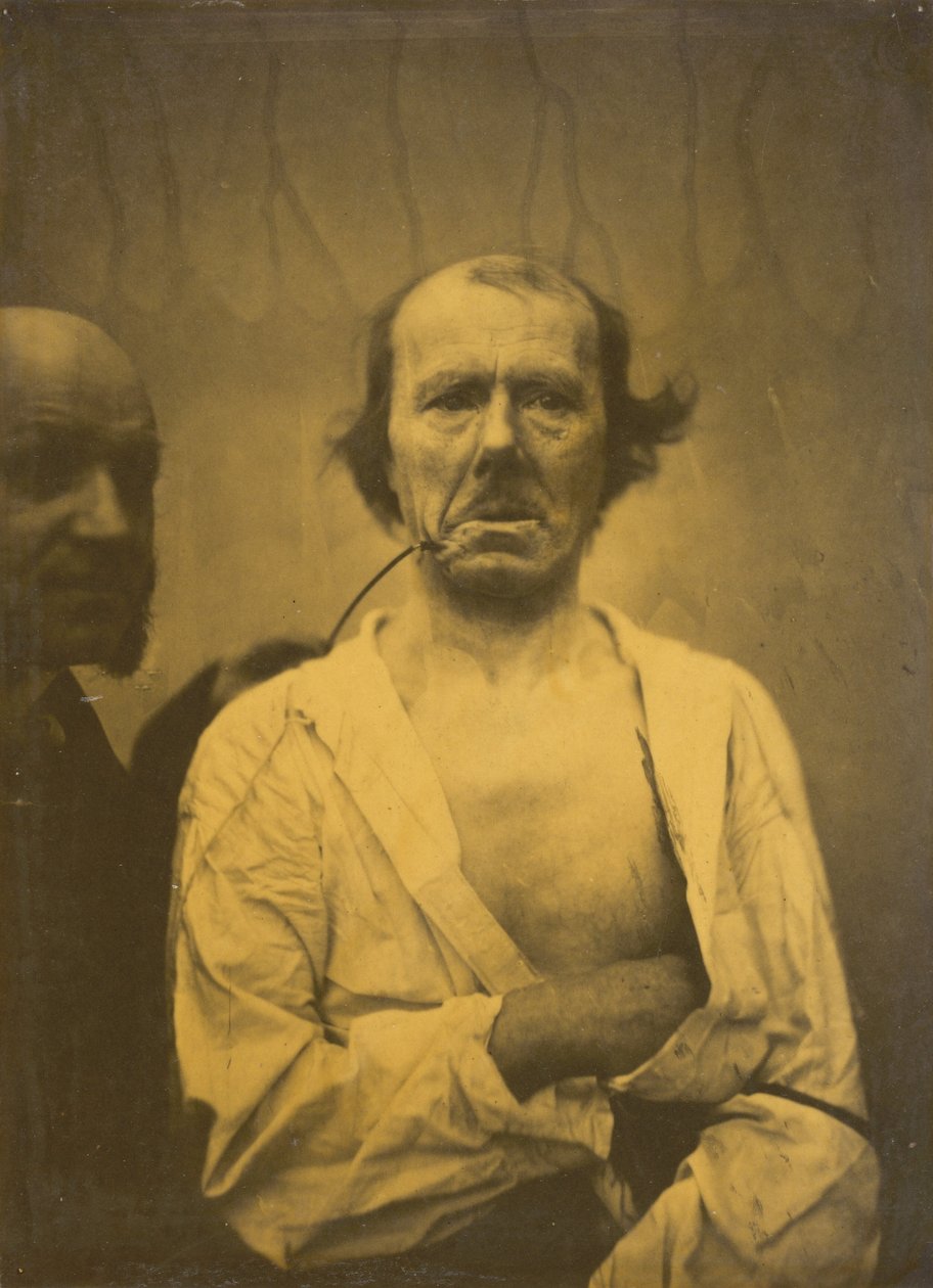 A Relaxed Expression (left); Disgust (right) by Guillaume Benjamin Amant Duchenne