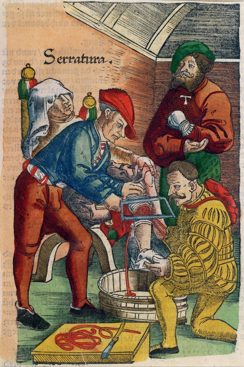 An Amputation, illustration from 