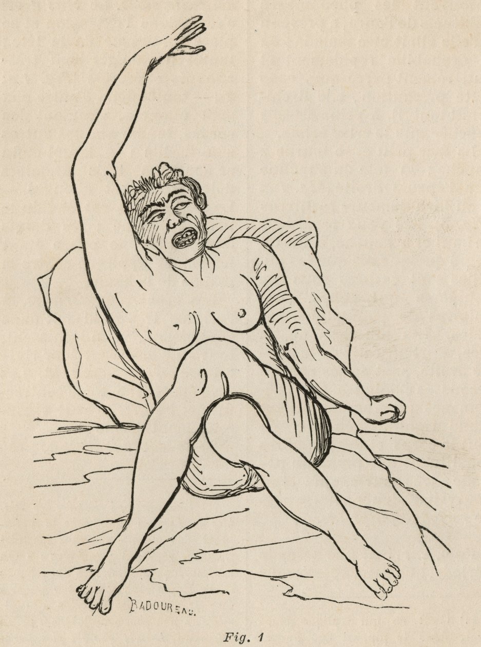 Hysterical Epilepsy, Attack, Contortions, fig. 1 from 