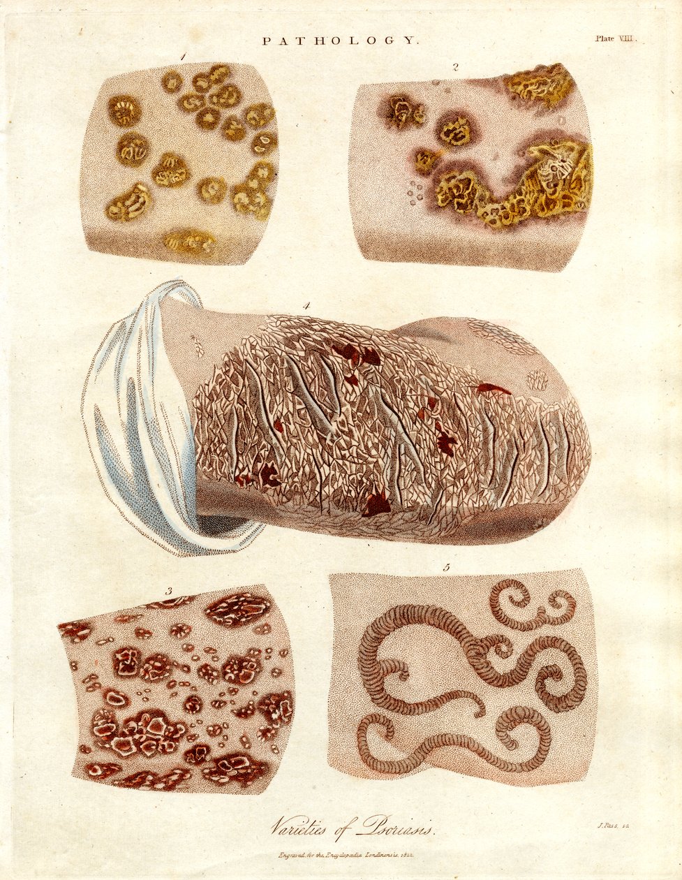 Pathological Skin Changes: Varieties of Psoriasis by John Pass