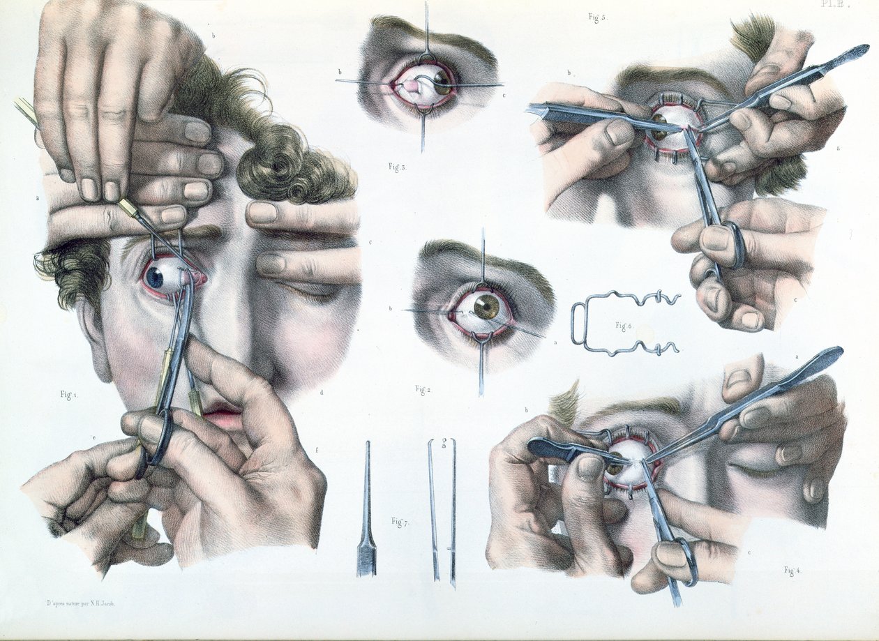 Operation on a strabismus, plate from 