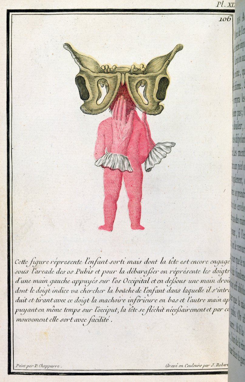 Cross-Sectional Diagram of a Baby Pulled from the Womb, from a Book by Madame Angelique Le Boursier du Coudray, engraved by J. Robert, 1783 by P. Chapparre