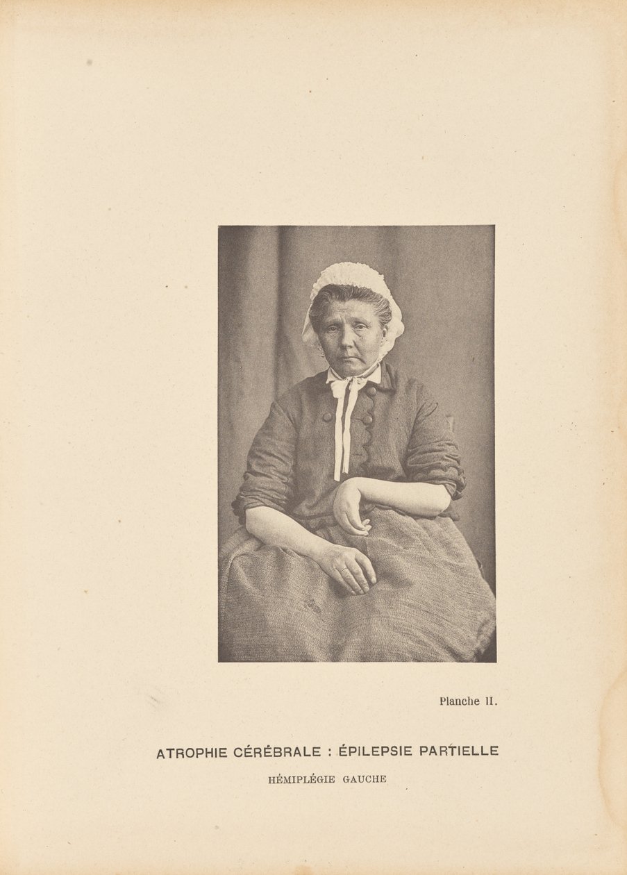 Cerebral Atrophy: Partial Epilepsy Left Hemiplegia by Paul Marie Léon Regnard