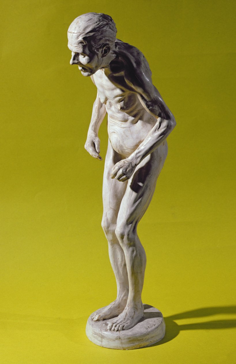Figure of a woman with Parkinson