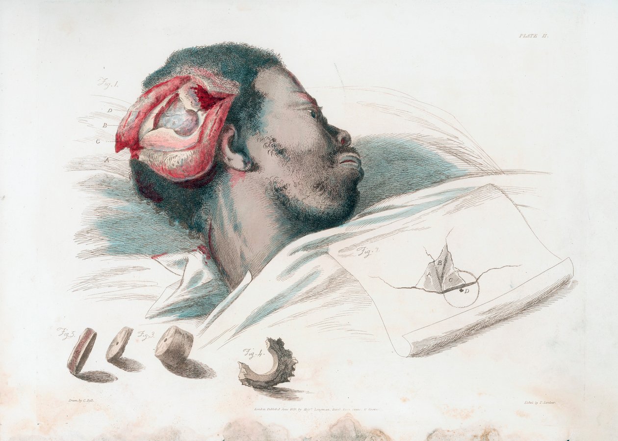 View of Wound in Skull after Trephination and Removal of Shattered Bone Piece at Bottom Left by Thomas Landseer