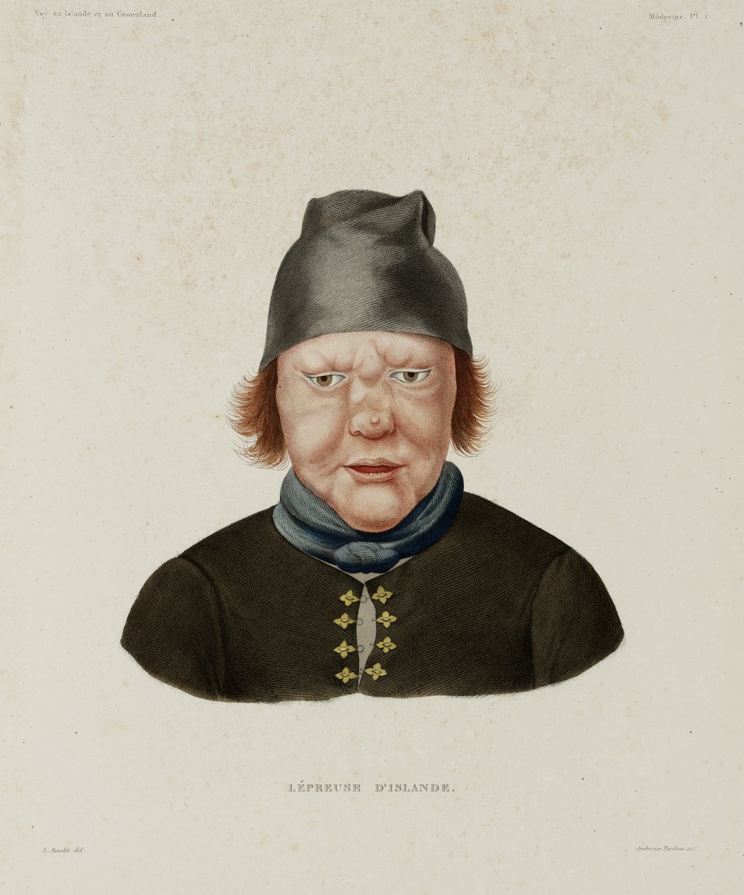 Diseases, Leprosy Female Leper, Iceland, early 19th century by Unbekannt