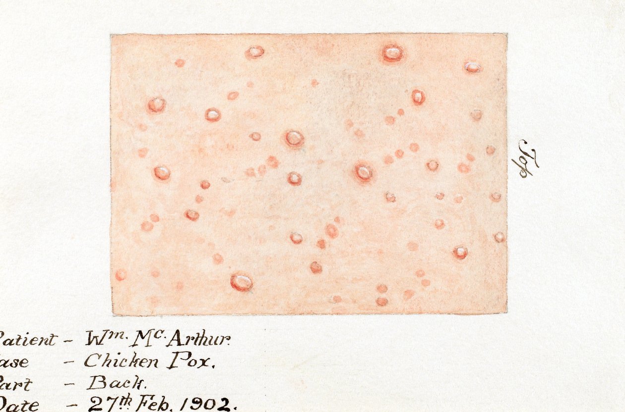 Diseases, Chickenpox by Unbekannt