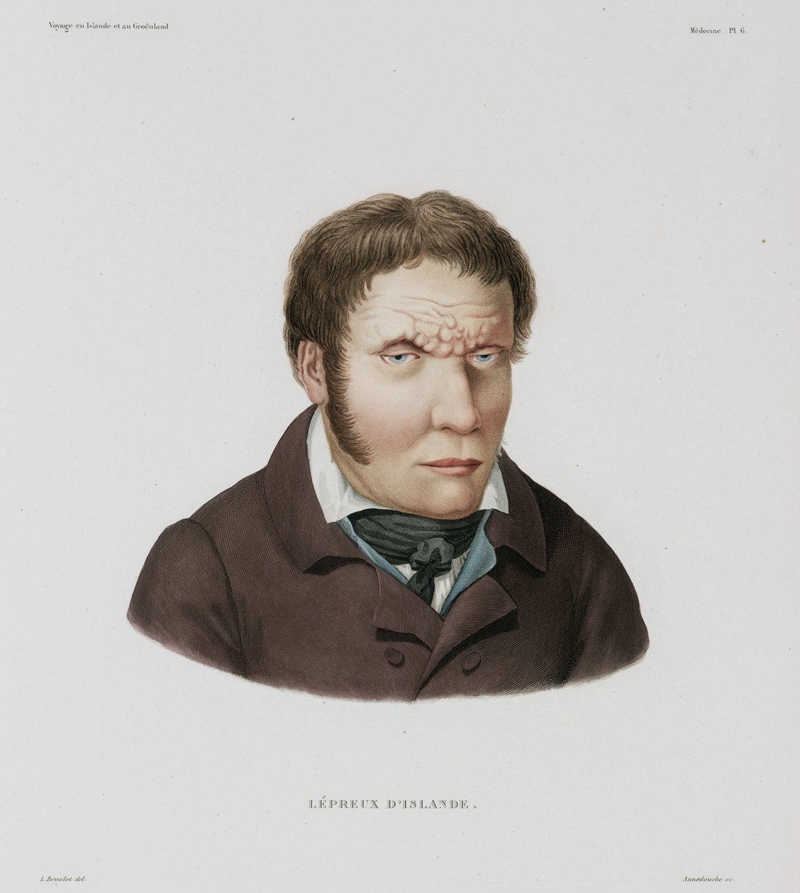 Diseases, Leprosy by Unbekannt
