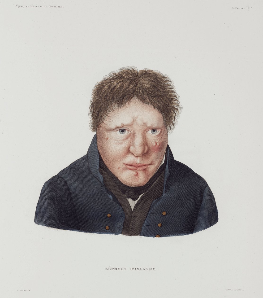 Diseases, Leprosy Male leper, Iceland, early 19th century by Unbekannt