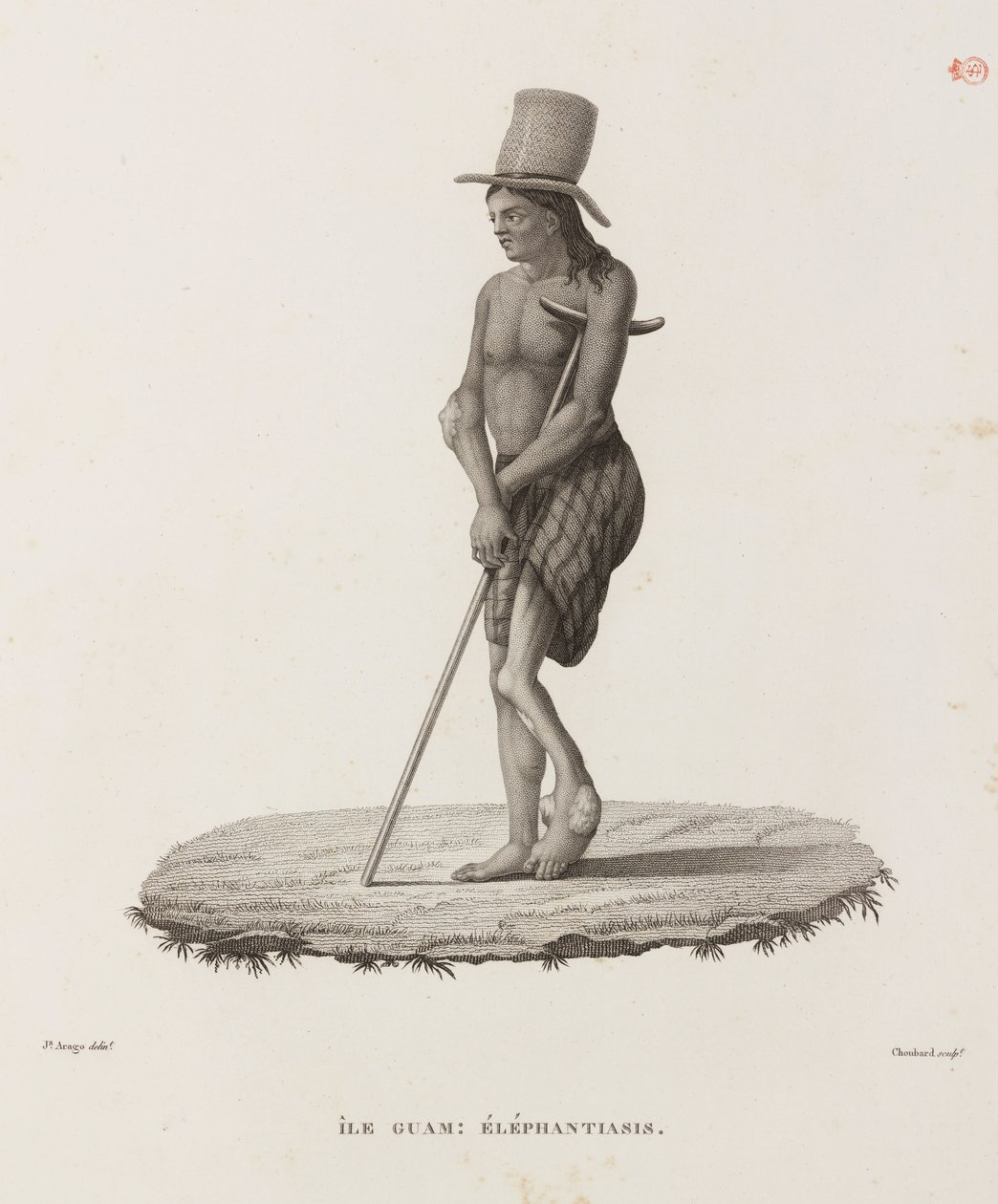 Diseases, Tropical Diseases Man with elephantiasis, Guam by Unbekannt