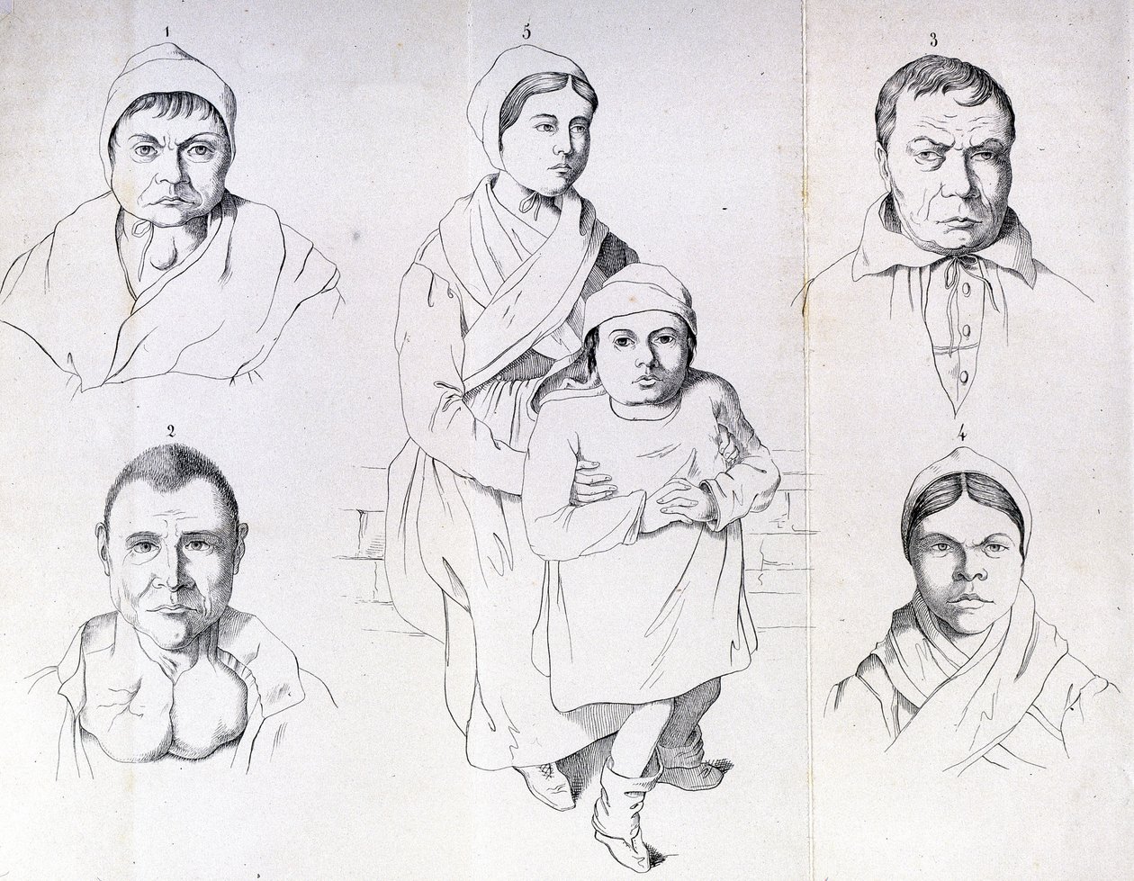 Considerations on the causes of endemic cretinism by Morel by Unknown artist