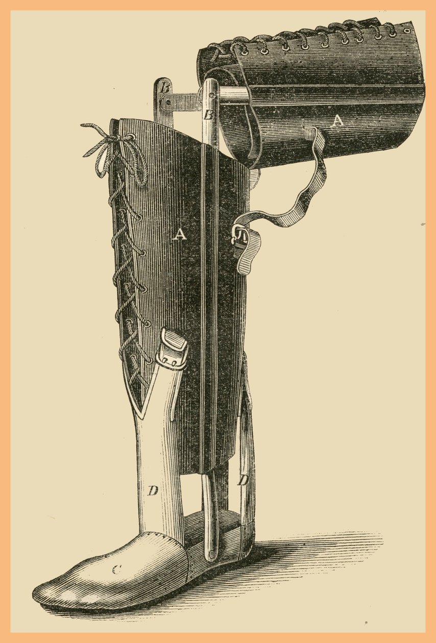 Leg Replacement by Unknown Artist