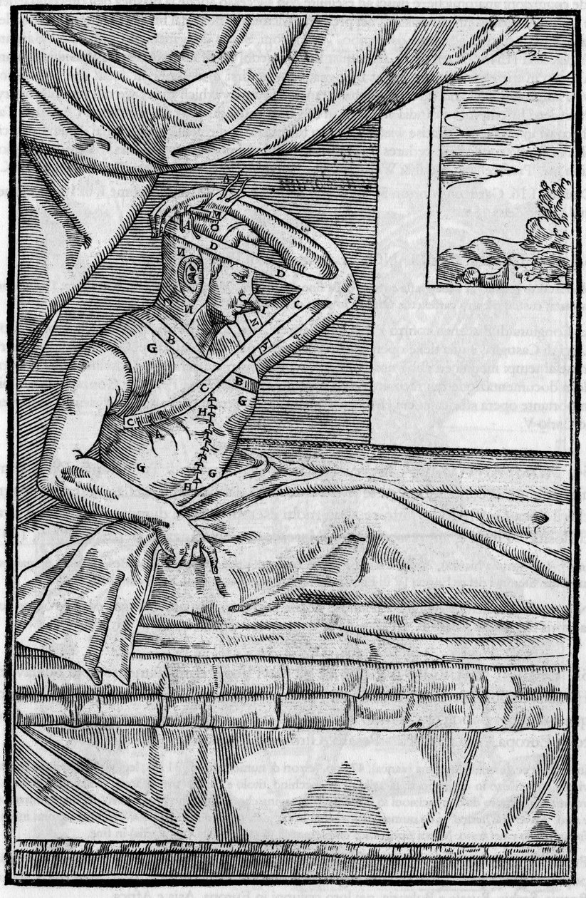 Nose surgery: Reconstructive surgery on the nose in De curtorum chirurgia per insitionem. Venice by Unknown artist