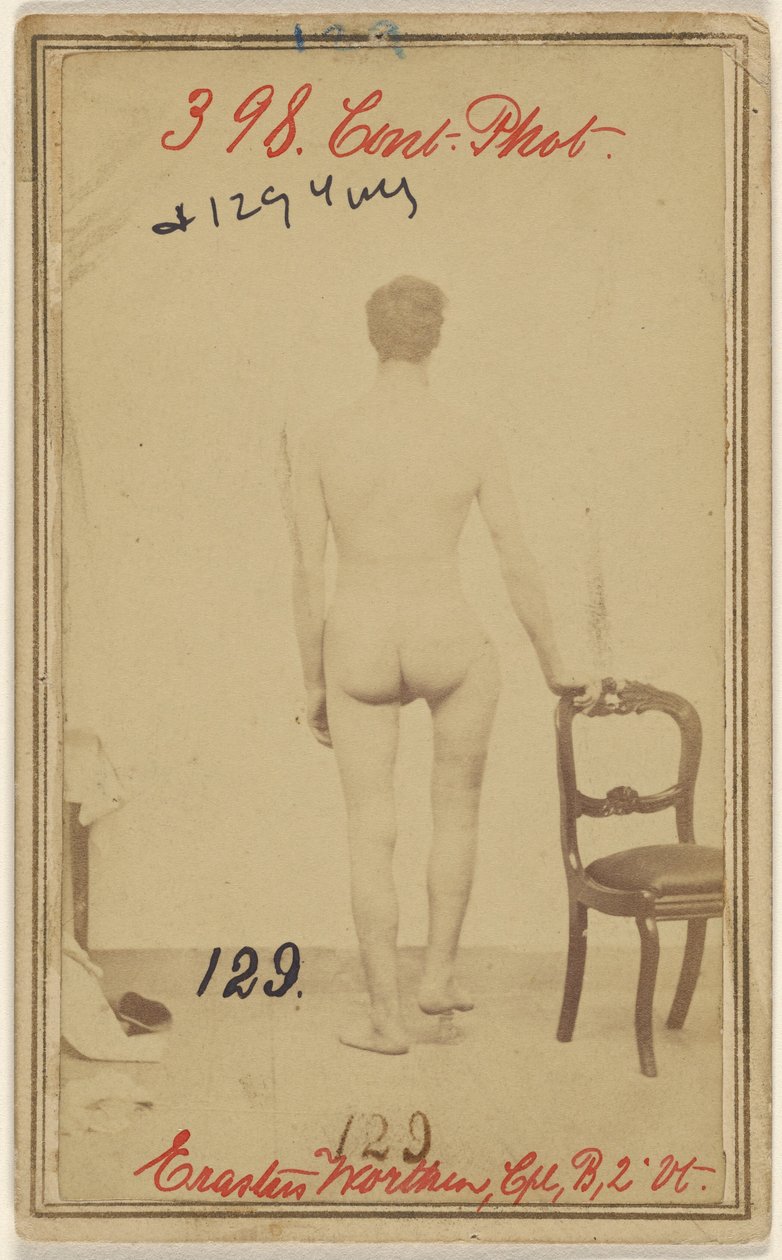 Fracture of the Upper Third of the Femur, Erastus Worthen, Corp Co. B. 2nd Vermont Vols, Aged 25, Residence Stockbridge VT by Unknown artist