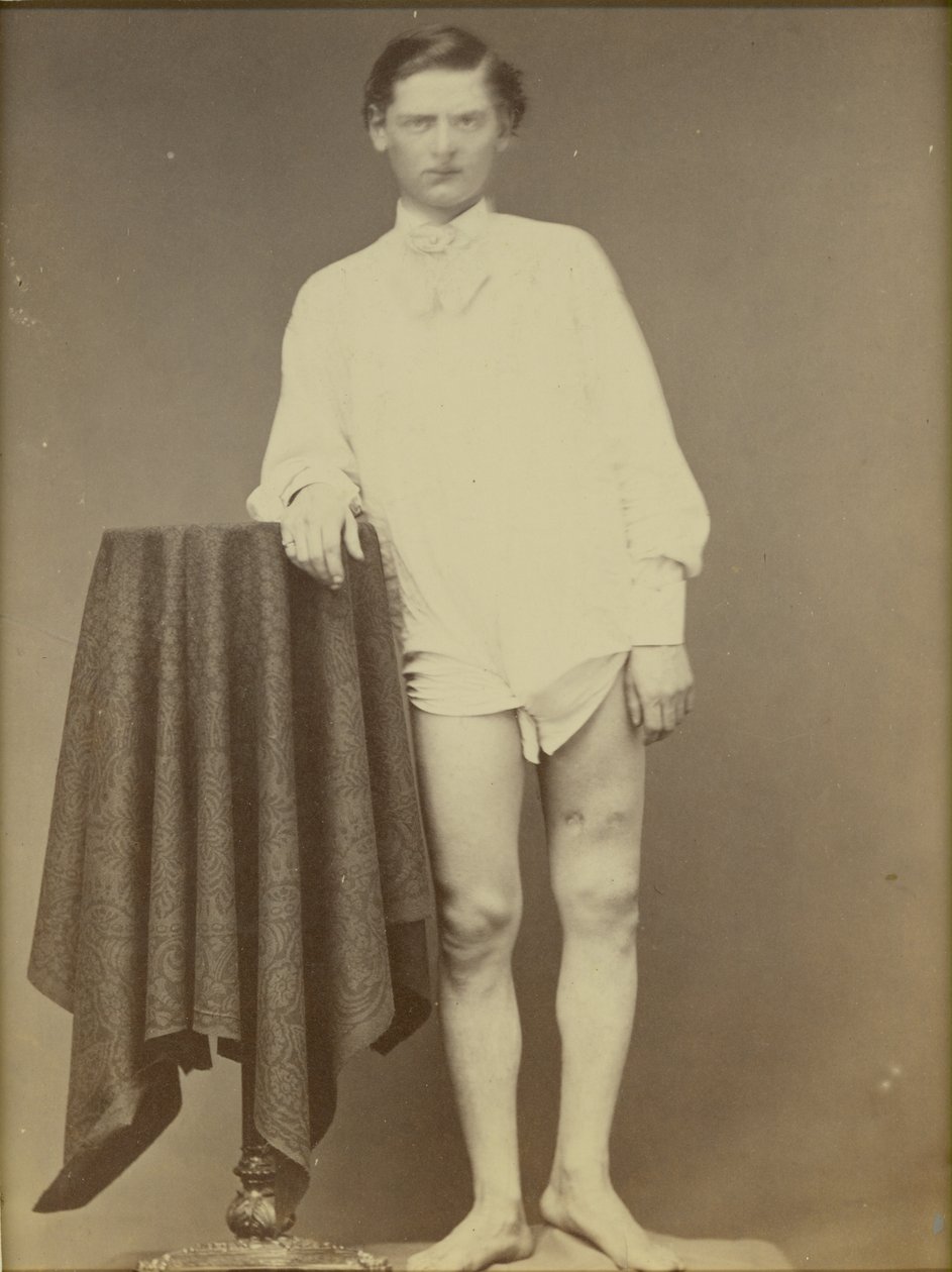 Injured Civil War Soldier (Private Charles Westerfield, Army Medical Museum Specimen No. 4278), April 1865 by William Abraham Bell