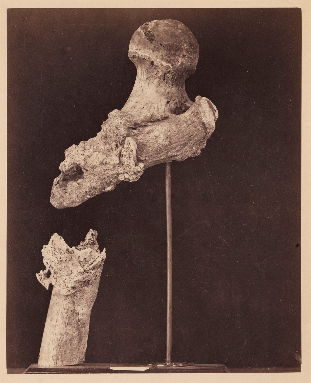 Lieutenant Goodwin, Deceased, Ununited Gunshot Fracture of the Upper Third of the Right Femur, Seven Months after the Injury, From the Photographic Catalogue of the Surgical Section by William Bell