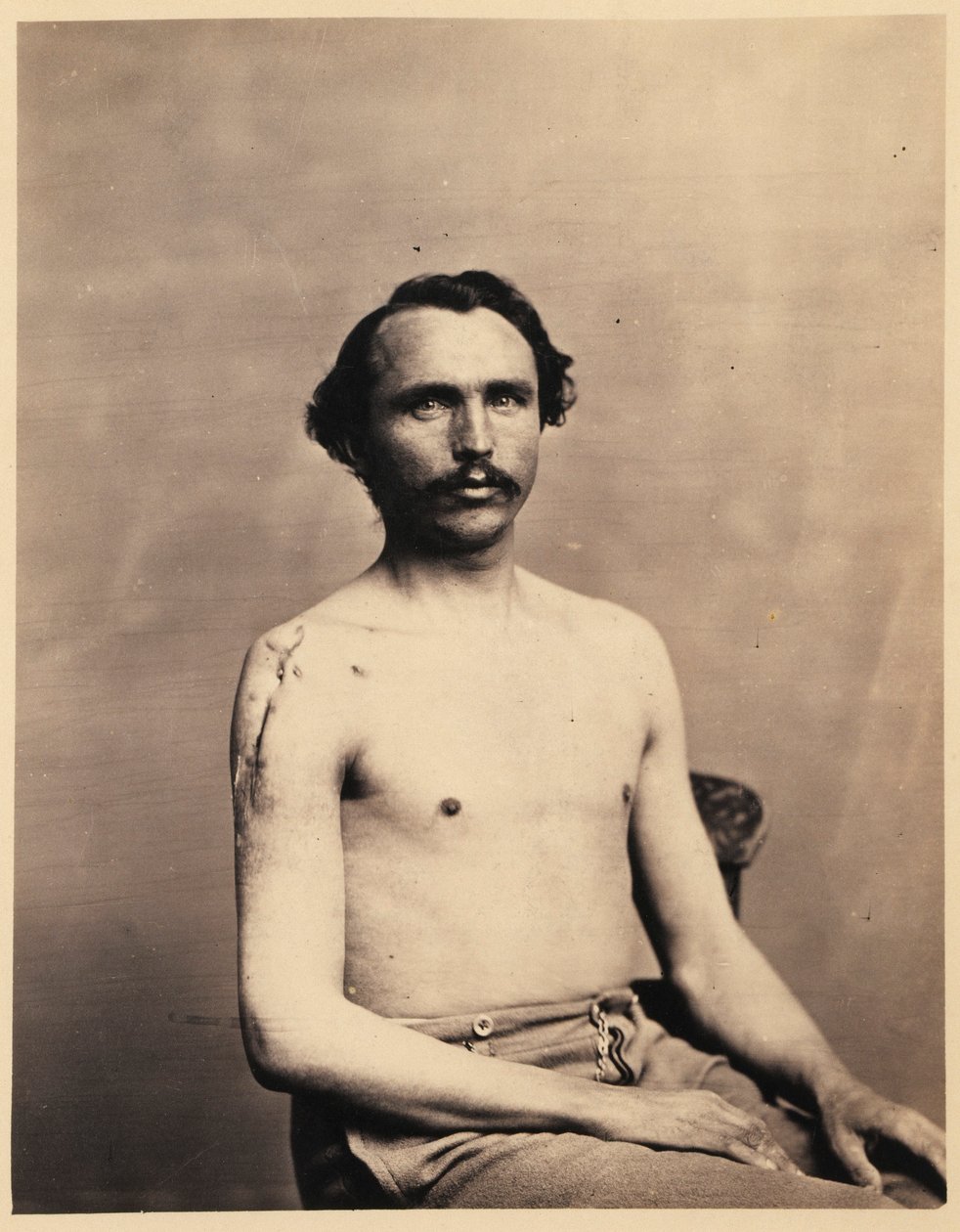 Private Adolph Zirsse, Successful Intermediate Excision of the Head and two and a half inches of the Shaft of the Right Humerus, from the Photographic Catalogue of the Surgical Section by William Bell