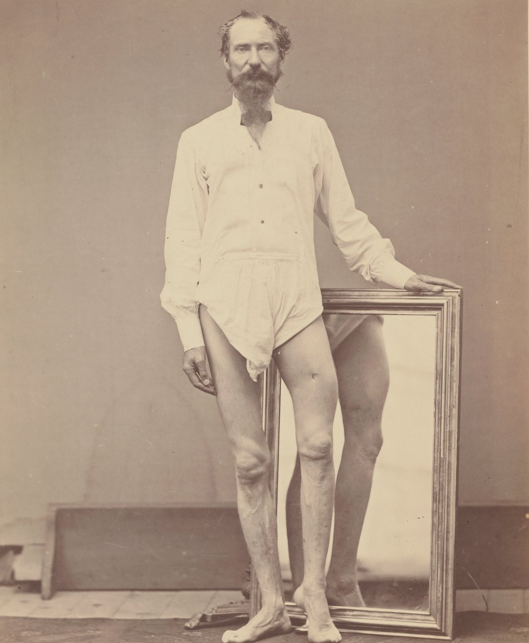Gunshot Wound of Middle Third of Left Femur by William H. Bell