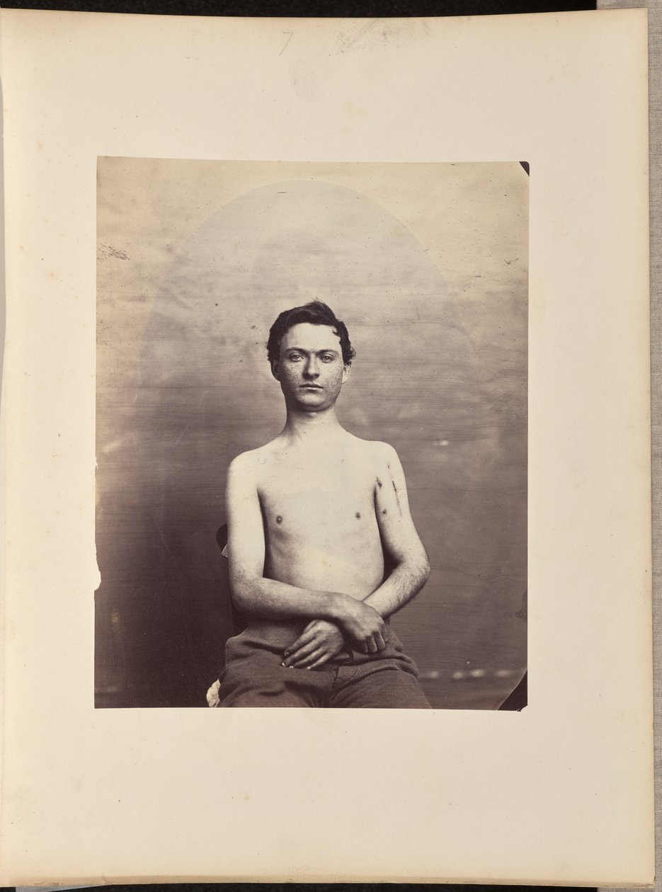 Recovery after Excision of the Head of the Left Humerus for Gunshot Fracture by William H. Bell