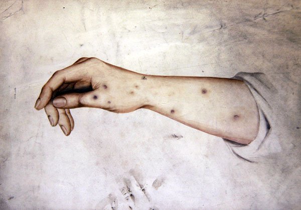 Study of a Forearm with skin condition, c.1850 by William Lover