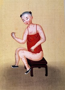 Child with smallpox
